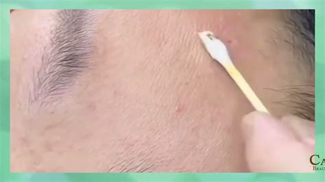 skin tag removal tampines